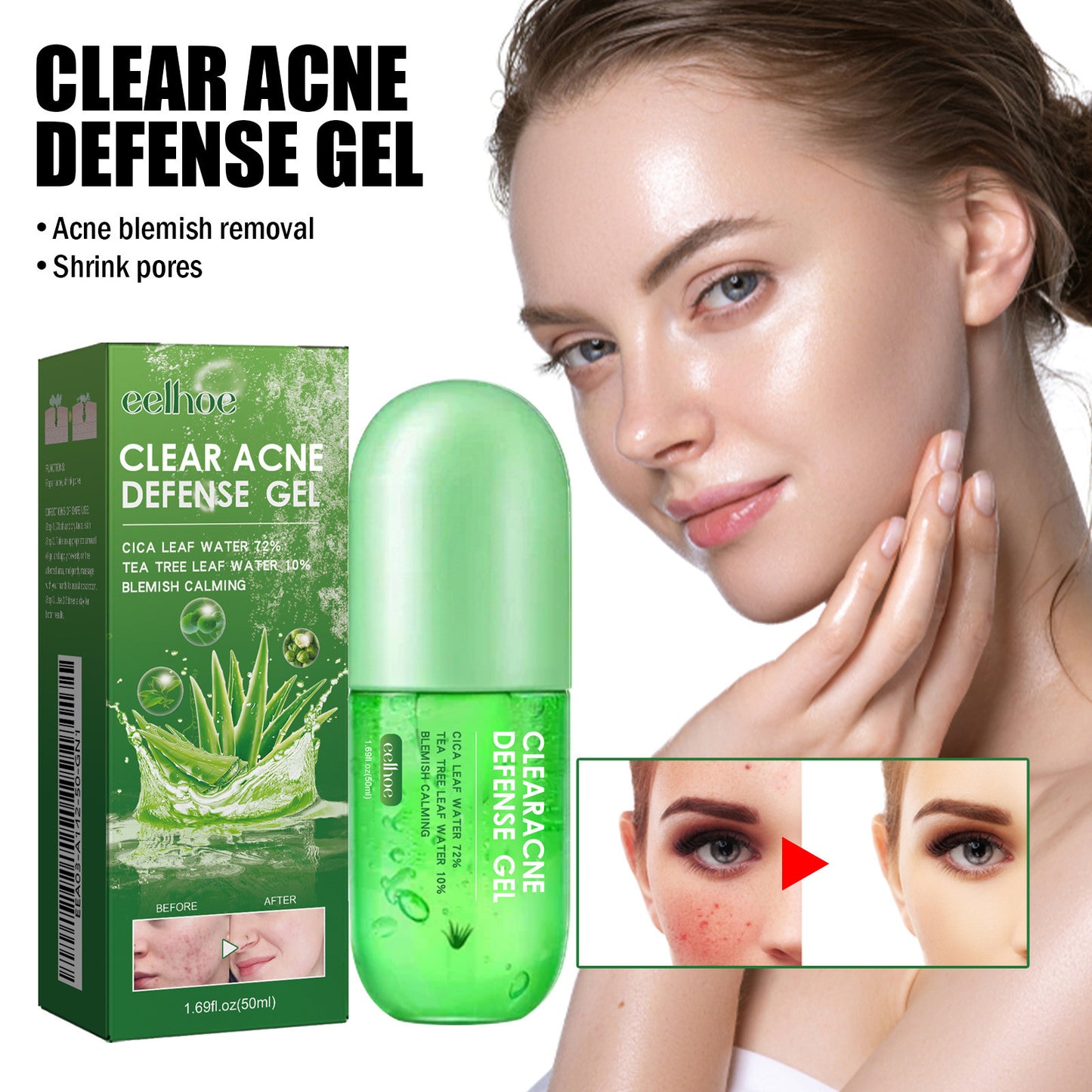 Acne Care Gel – Soothing Relief for Clearer Skin - Blessed Corner