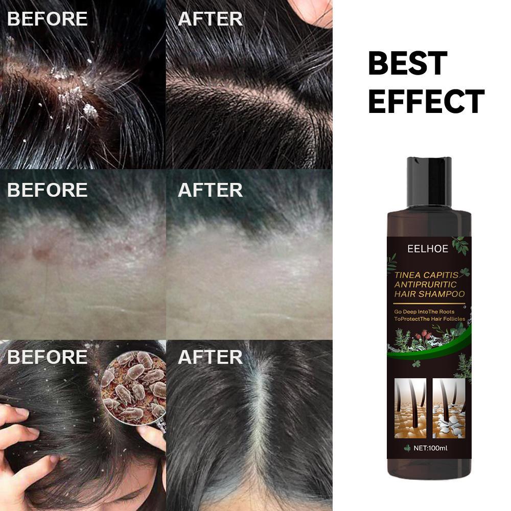Anti-Dandruff Shampoo - Itch Relief, Hair Loss Prevention, Oil Control & Refreshing Care - Blessed Corner