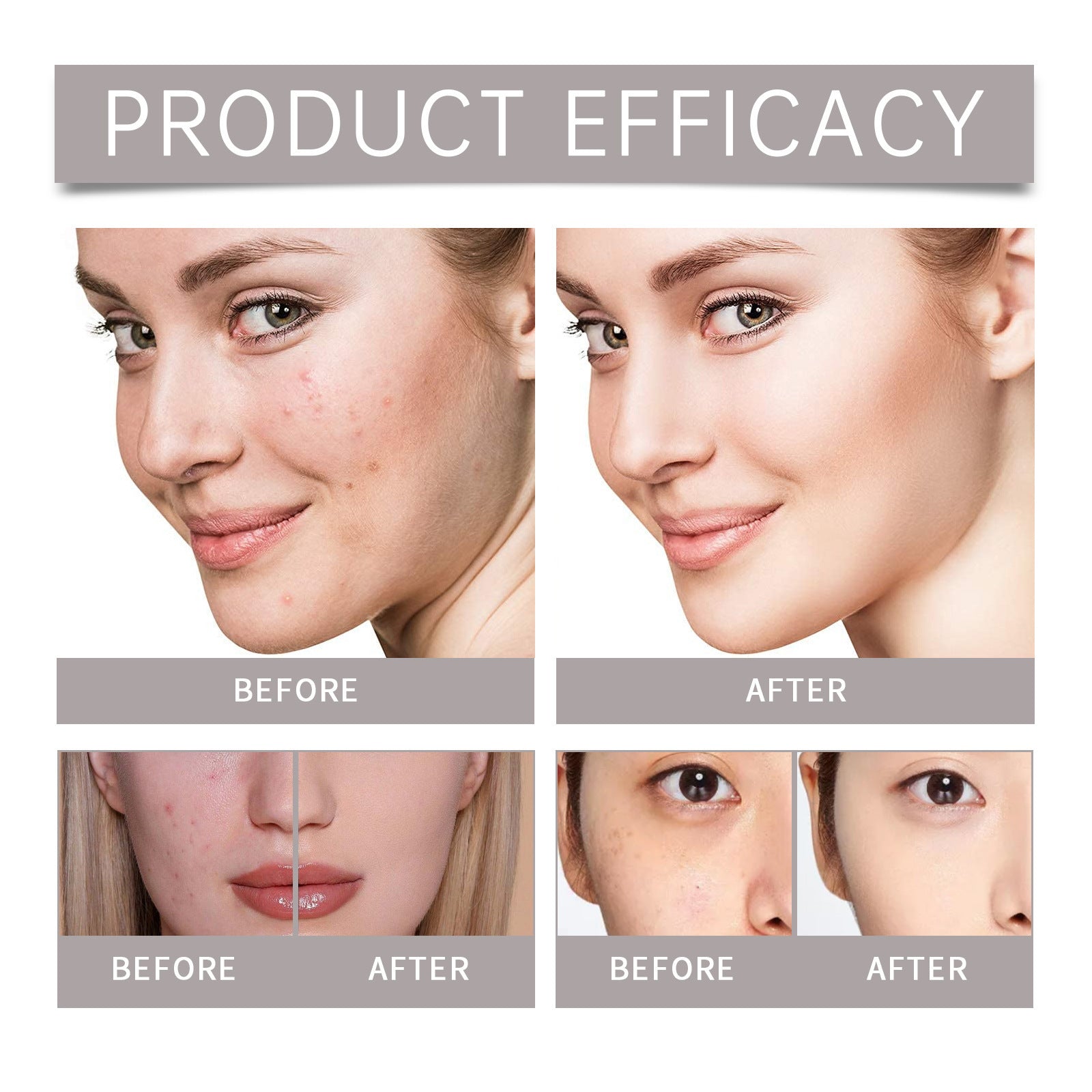 Anti-Acne Care Suit – Skin And Moisturizes - Blessed Corner